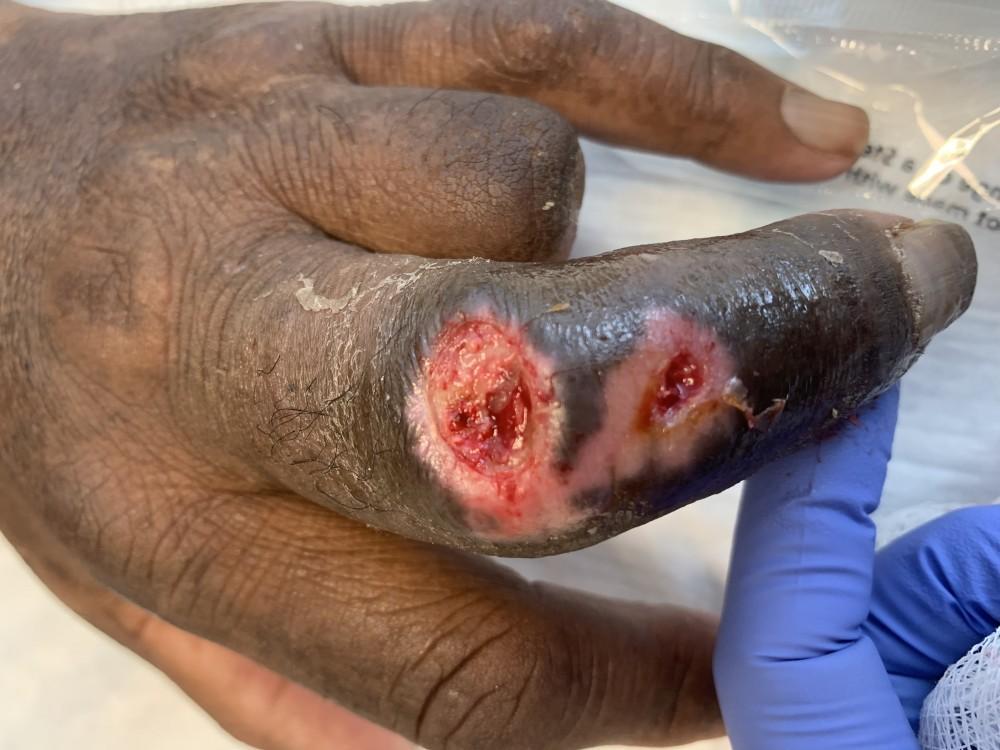 Open Wound Care: What Happens When You Put Salt on a Cut?