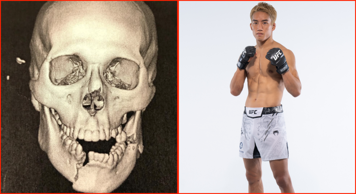 Kai Asakura Jaw Broken: What Happened and How Hes Doing?