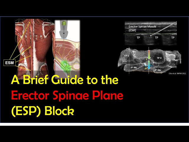 Getting an esp nerve block? Here's what you can easily expect during the treatment process.