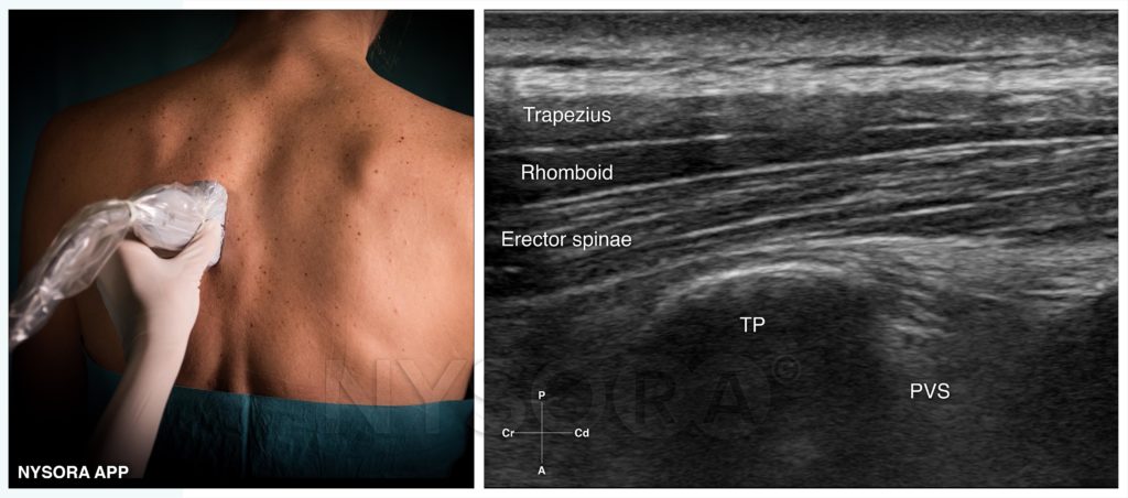 Getting an esp nerve block? Here's what you can easily expect during the treatment process.