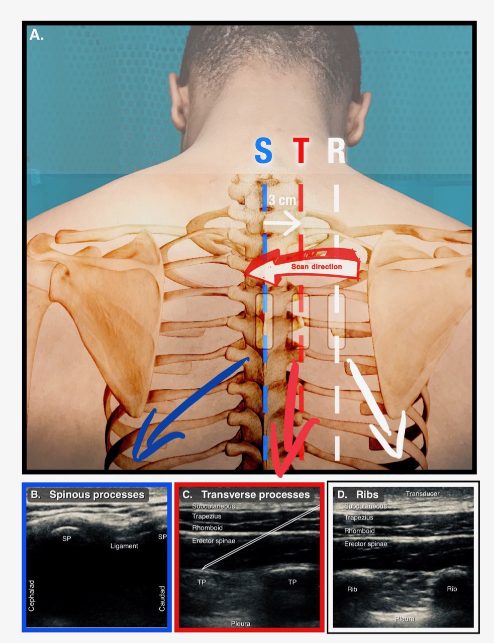 Getting an esp nerve block? Here's what you can easily expect during the treatment process.